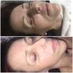 Radiofrequência com revitalização facial.