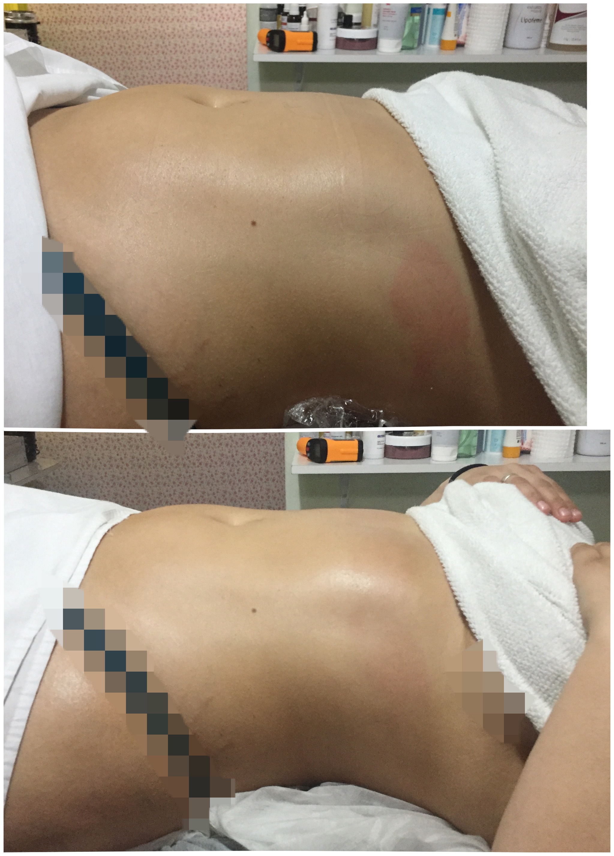 Drenagem  estética esteticista