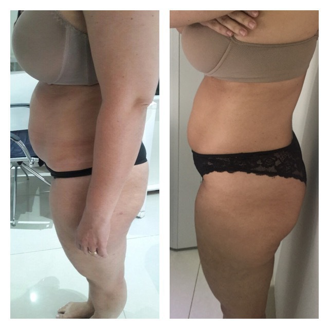Redux Detox,15 Sessões. estética esteticista