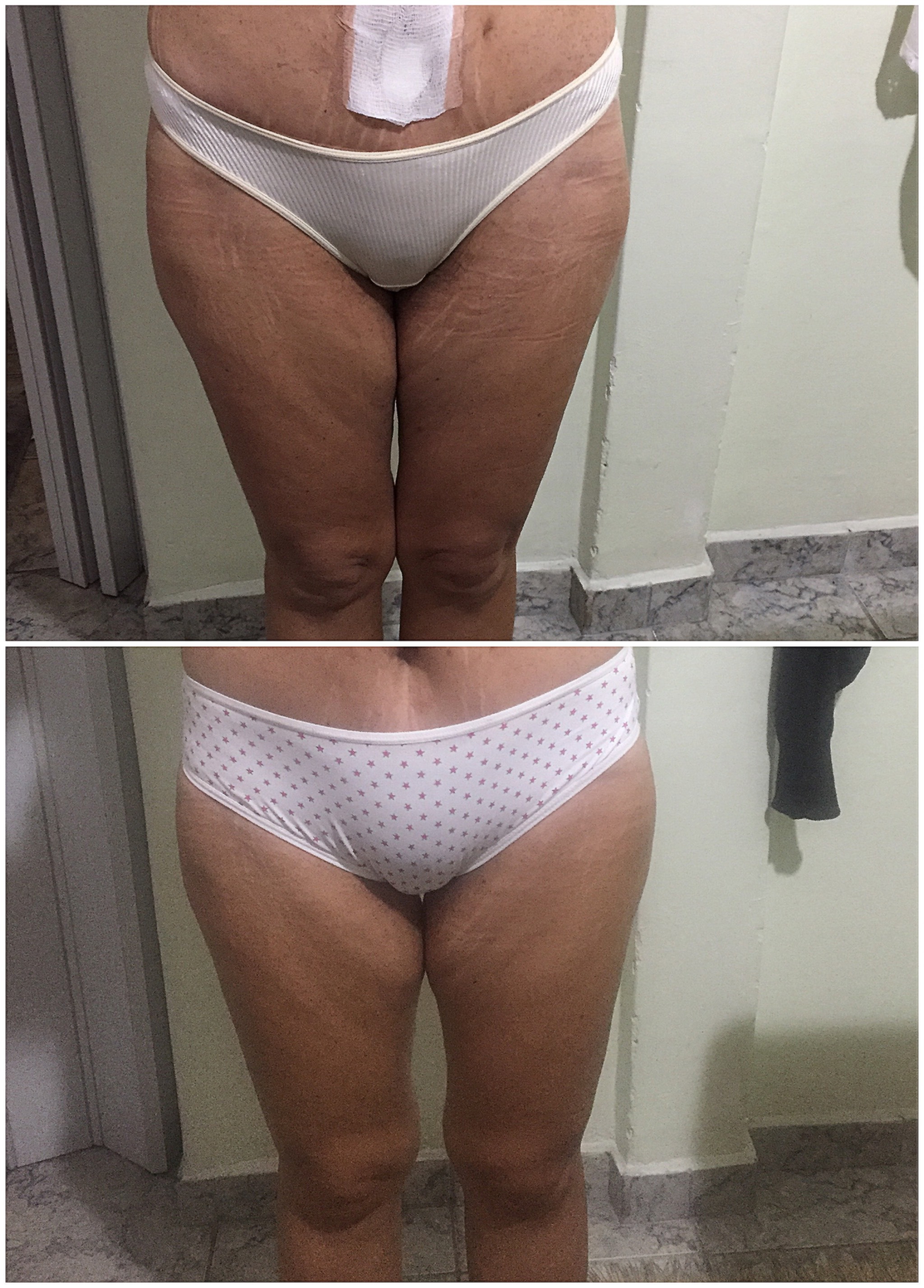 Flacidez de interno de coxa, cliente realizou um procedimento de cirurgia bariátrica e cirurgia de abdomenoplastia. estética esteticista