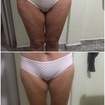 Flacidez de interno de coxa, cliente realizou um procedimento de cirurgia bariátrica e cirurgia de abdomenoplastia.