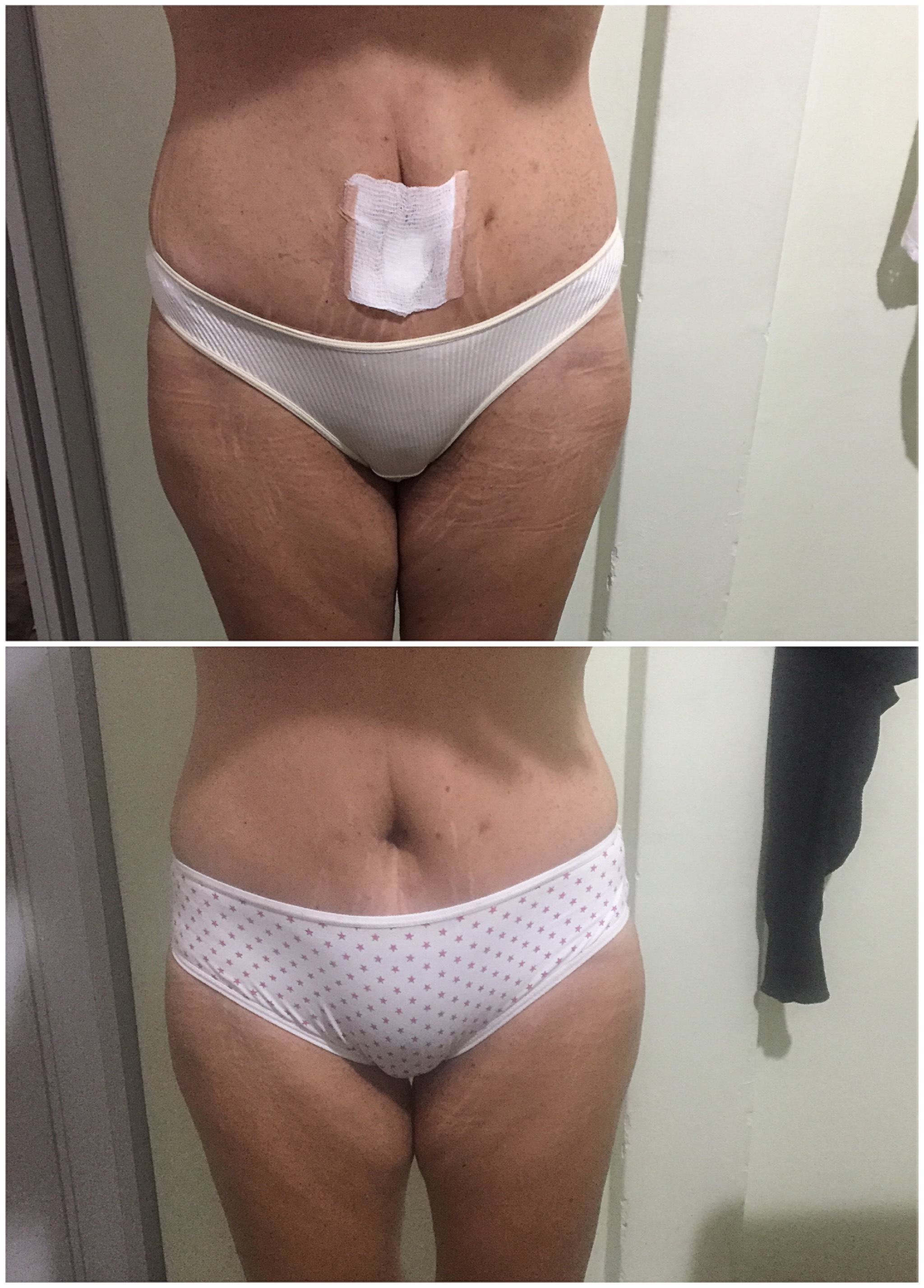 Drenagem pós cirúrgica, de abdôme 7 Sessões. estética esteticista