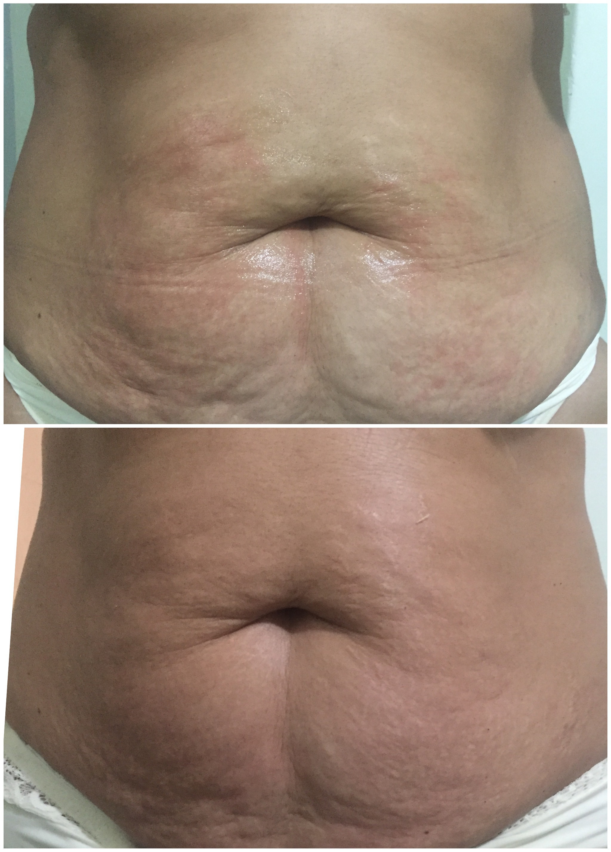 Tratamento para flacidez com Radiofrequência. 10 Sessões  estética esteticista