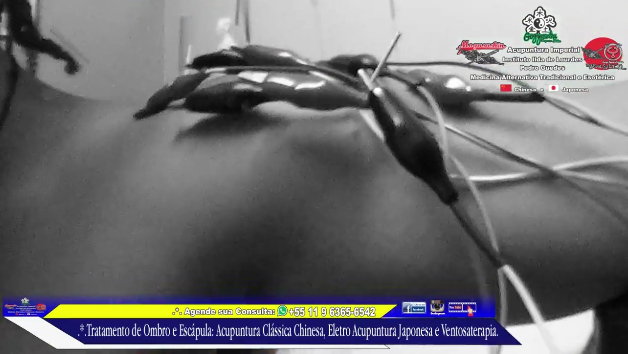 .*. Tratamento de Ombro e Escapula Acupuntura Clássica Chinesa e Eletro-Acupuntura Japonesa. outros acupunturista docente / professor(a)