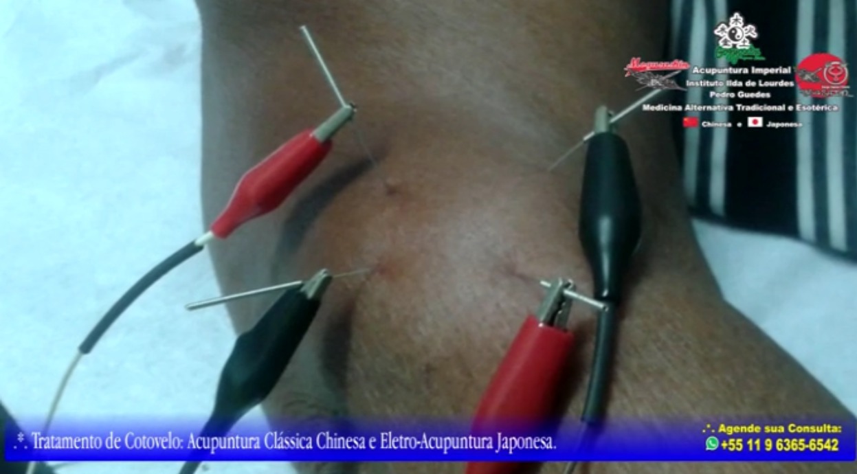 .*. Tratamento de Epicondilite de Cotovelo (Cotovelo de Tenista). 
Acupuntura Clássica Chinesa e Eletro-Acupuntura Japonesa. outros acupunturista docente / professor(a)