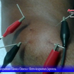 .*. Tratamento de Epicondilite de Cotovelo (Cotovelo de Tenista). 
Acupuntura Clássica Chinesa e Eletro-Acupuntura Japonesa.