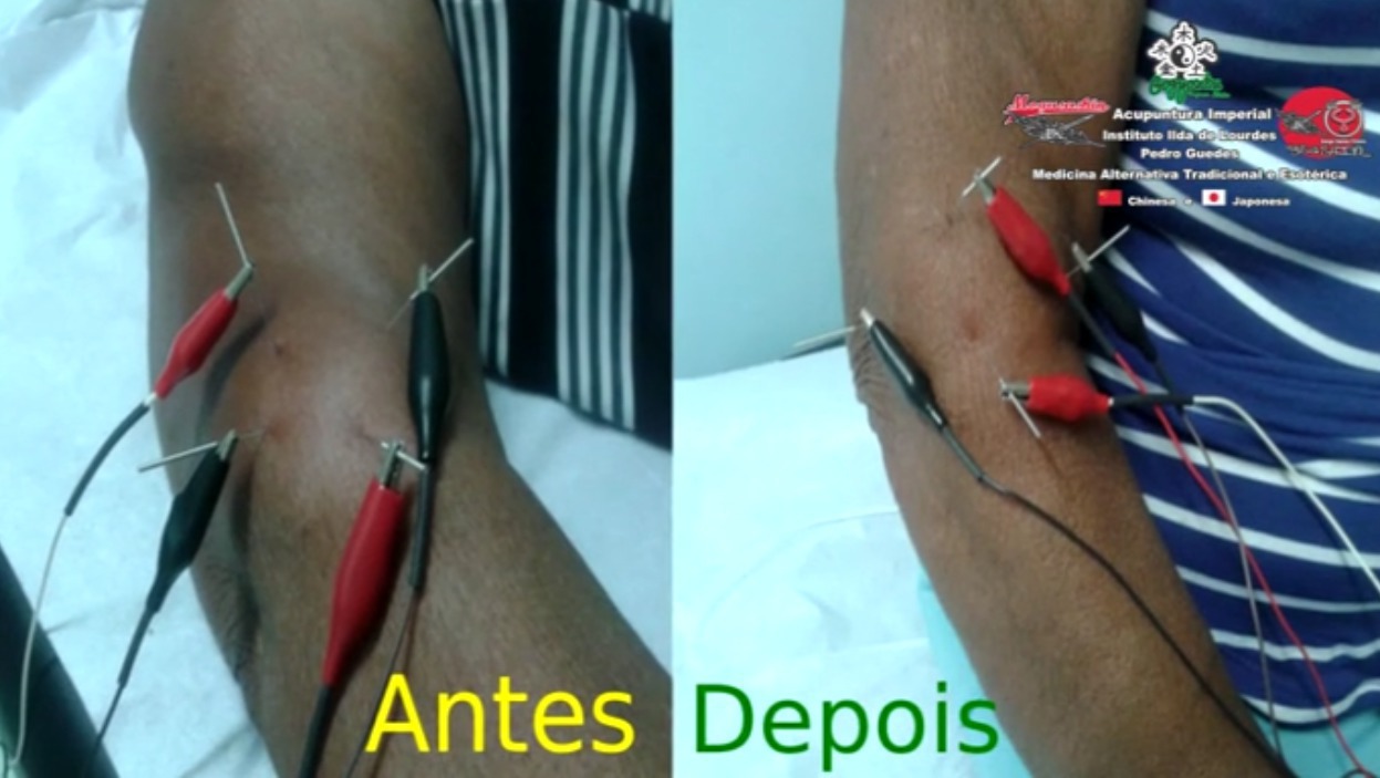 .*. Tratamento de Epicondilite de Cotovelo (Cotovelo de Tenista). Acupuntura Clássica Chinesa e Eletro-Acupuntura Japonesa. outros acupunturista docente / professor(a)