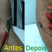 .*. Tratamento de Epicondilite de Cotovelo (Cotovelo de Tenista). Acupuntura Clássica Chinesa e Eletro-Acupuntura Japonesa.