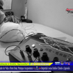 .*. Tratamento de 1º metacarpo e 1º Falange Proximal do Polegar. Acupuntura Clássica Chinesa.  junto com Eletro-Acupuntura Japonesa.