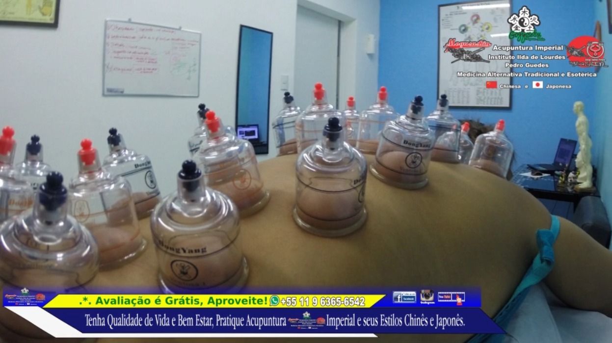 .*. Tratamento de Ventosa-Terapia  Traz Rejuvenescimento ao Tecido Muscular, Filtra e Decompõe as Toxinas dos Vasos Capilares e Auxilia na Troca Gasosa do Tecido da Epiderme.  outros acupunturista docente / professor(a)