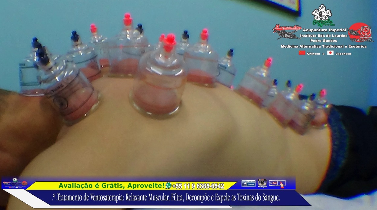 .*. Tratamento de Ventosa-Terapia  Traz Rejuvenescimento ao Tecido Muscular, Filtra e Decompõe as Toxinas dos Vasos Capilares e Auxilia na Troca Gasosa do Tecido da Epiderme.  outros acupunturista docente / professor(a)
