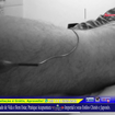 .*. Tratamento de Perna Nervo Ciático. Acupunura Clássica Chinesa e Eletro-Acupuntura Japonesa.