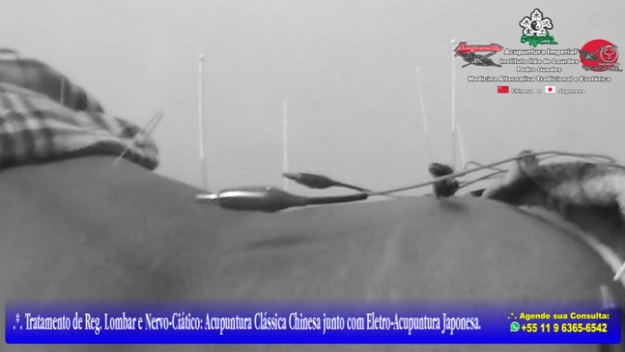 Tratamento de Lombar e Nervo Ciático Acupuntura Clássica Chinesa e Eletro Acupuntura Japonesa.  outros acupunturista docente / professor(a)