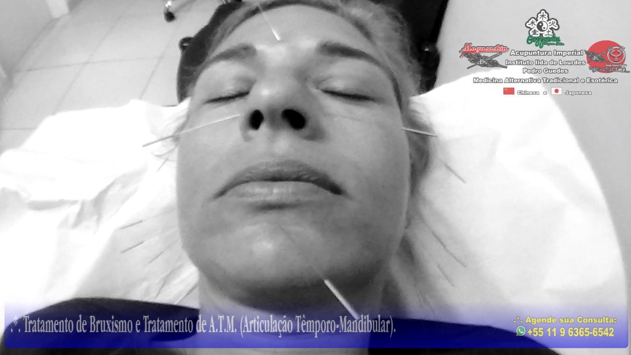 .*. Tratamento de Bruxismo, A.T.M (Articulação Têmporo-Mandibular) e Nervo Trigêmeo (Ramos Temporal, Zigomático e Mandibular), Acupuntura Clássica Chinesa e Acupuntura para Rejuvenescimento Facial. outros acupunturista docente / professor(a)
