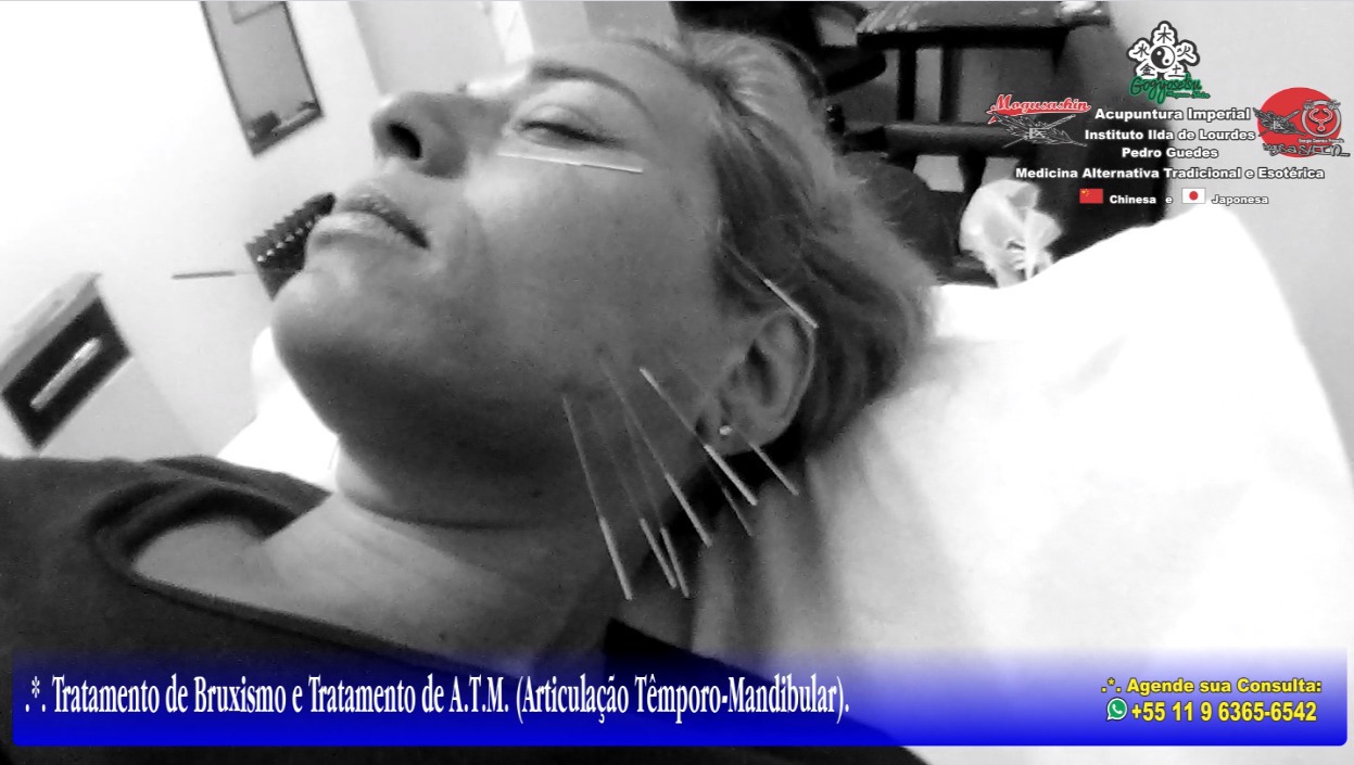 .*. Tratamento de Bruxismo, A.T.M (Articulação Têmporo-Mandibular) e Nervo Trigêmeo (Ramos Temporal, Zigomático e Mandibular), Acupuntura Clássica Chinesa e Acupuntura para Rejuvenescimento Facial. outros acupunturista docente / professor(a)