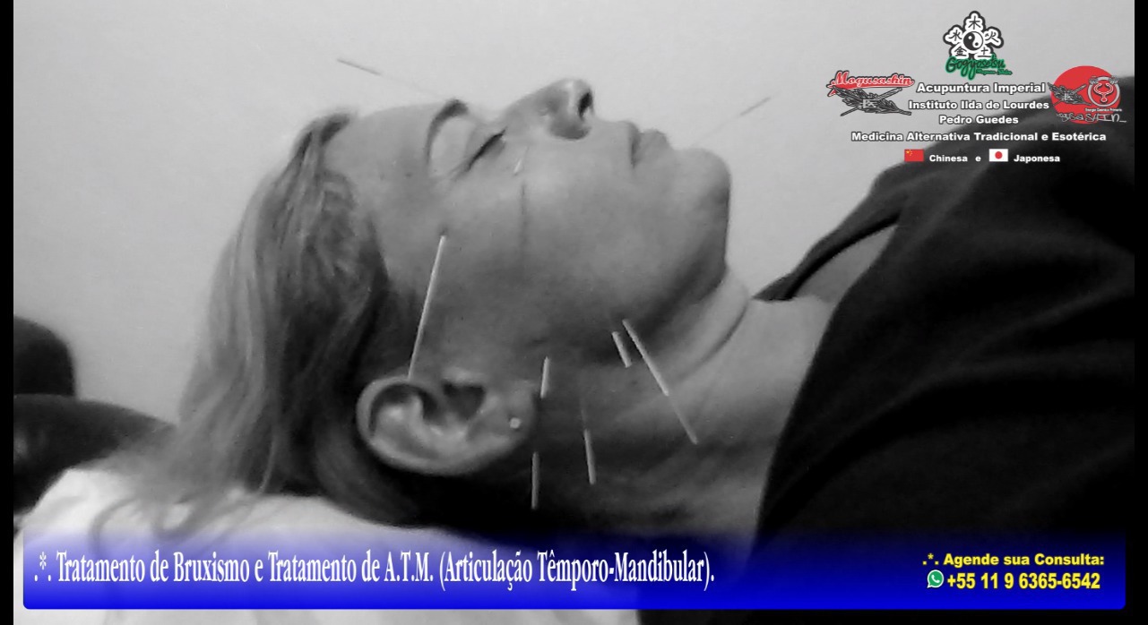 .*. Tratamento de Bruxismo, A.T.M (Articulação Têmporo-Mandibular) e Nervo Trigêmeo (Ramos Temporal, Zigomático e Mandibular), Acupuntura Clássica Chinesa e Acupuntura para Rejuvenescimento Facial. outros acupunturista docente / professor(a)