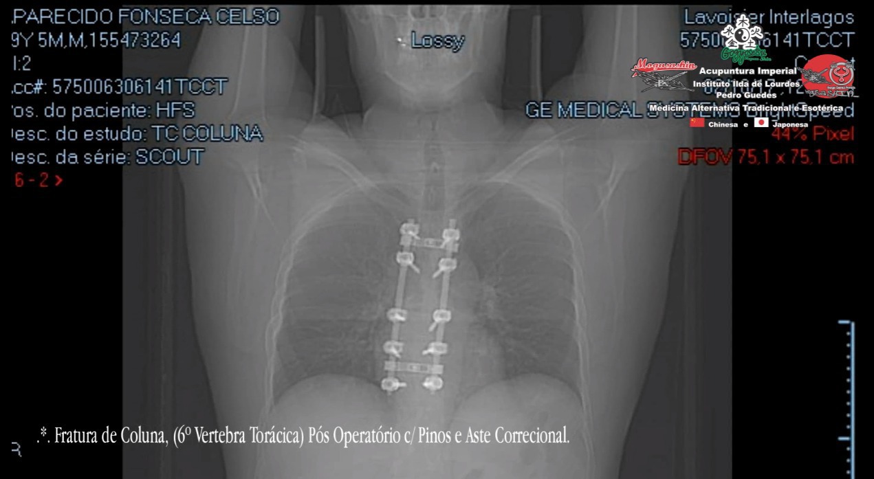 .*. Fratura de 6º Vértebra Torácica. Pós Operatório c/ Haste Correcional. outros acupunturista docente / professor(a)