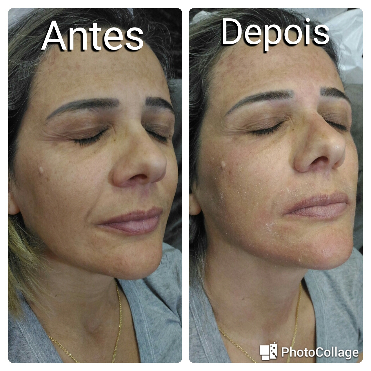 Microagulhamento (1° sessão) estética designer de sobrancelhas micropigmentador(a) dermopigmentador(a) maquiador(a) depilador(a) estudante (esteticista)