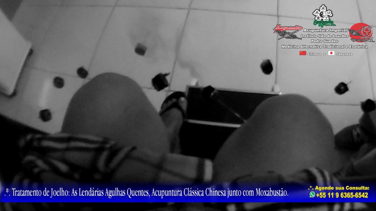 .*. Tratamento de Artrite e Artrose de Joelhos Acupuntura Clássica e Moxabustão (Agulhas Quentes). outros acupunturista docente / professor(a)