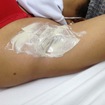 Argiolotetapia
Procedimento: clareamento nas axilas.