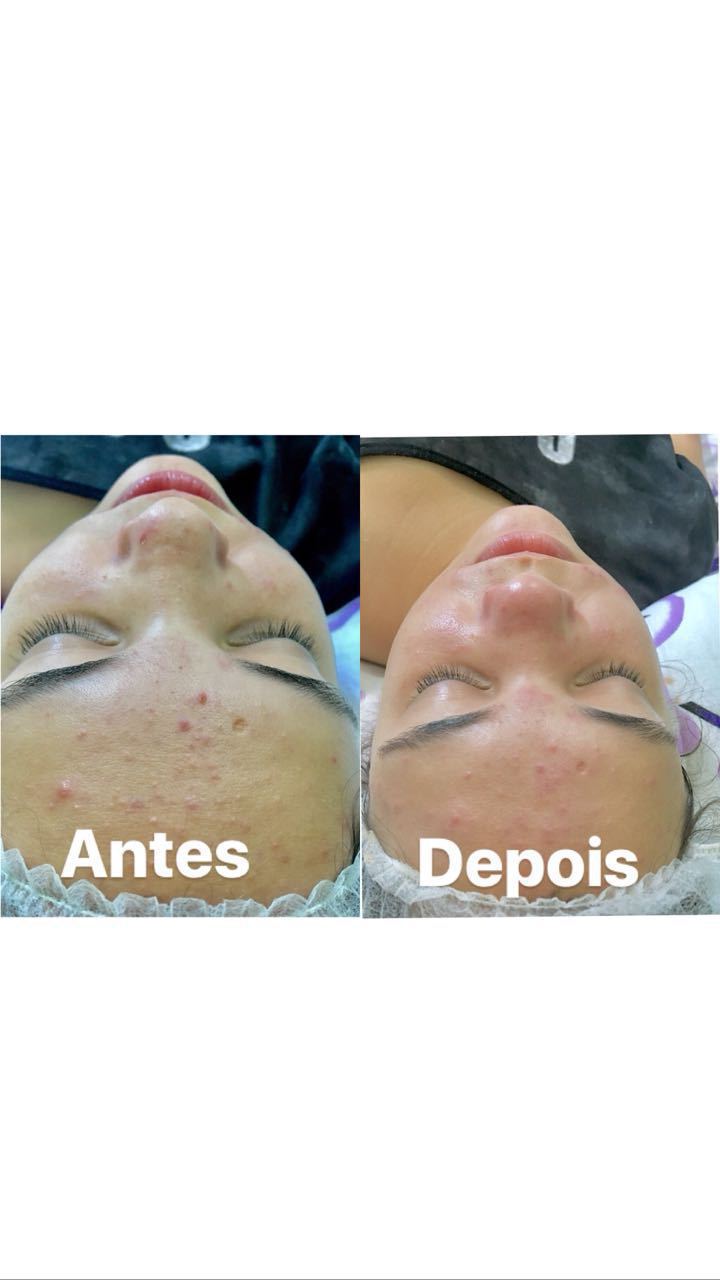 Limpeza de pele com extração. estética micropigmentador(a) assistente esteticista designer de sobrancelhas estudante (esteticista)