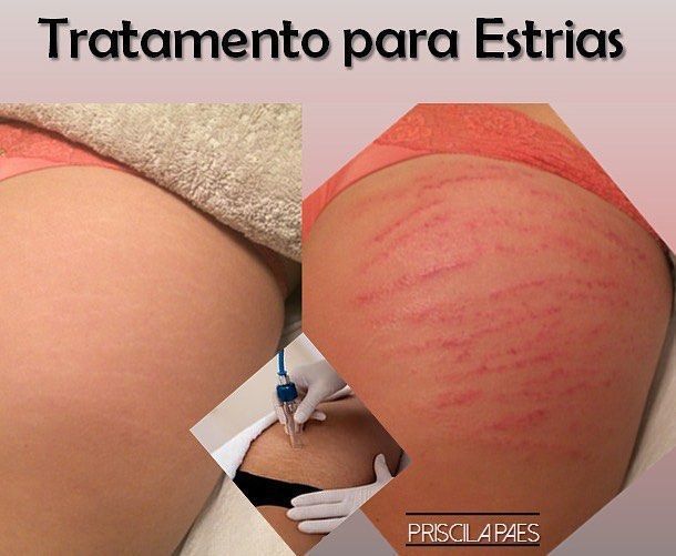 🌟Vacuoterapia em estrias
.
✅ Não é invasivo.
.
✔️ O tratamento é feito com uma ponteira que promove a sucção a vácuo, fazendo com que o sangue volte a circular internamente na região, estimulando a produção de colágeno e elastina!🔝
..
#esteticacorporal #xoestrias #vacuoterapia #priscilapaesesteticista estética esteticista micropigmentador(a)
