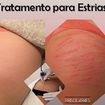 🌟Vacuoterapia em estrias
.
✅ Não é invasivo.
.
✔️ O tratamento é feito com uma ponteira que promove a sucção a vácuo, fazendo com que o sangue volte a circular internamente na região, estimulando a produção de colágeno e elastina!🔝
..
#esteticacorporal #xoestrias #vacuoterapia #priscilapaesesteticista