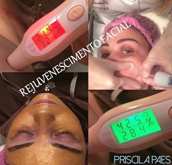 ❓ VOCÊ SABE O QUE É REVITALIZAÇÃO, E OS SEUS BENEFÍCIOS ❓
.
⭐ A revitalização facial é um procedimento estético que propicia a renovação celular da pele e uma profunda hidratação.
.
⭐ É uma técnica regeneradora, nutritiva que favorece o rejuvenescimento, mantendo o equilíbrio dos nutrientes, e o PH da pele.
.
⭐ Promove uma aparência saudável, hidratada e jovial. Ajuda no retardo do processo natural do envelhecimento, tornando a pele mais viçosa e luminosa.
.
♦ BENEFÍCIOS ♦
.
✅ Protege a pele contra os radicais livres que causam danos na pele, prevenindo o envelhecimento precoce;
✅ Ajuda a clarear manchas na pele, fazendo a retirada das células mortas;
✅ Melhora a textura, assim como a maciez;
✅ Nutre e combate o aparecimento de rugas e linhas de expressão. .
✨ CUIDE-SE!!! Venha já fazer a sua! 💖

#priscilapaesesteticista #esteticafacial #rejuvenescimentofacial #vacuoterapia #mascaradeouro #analisedepele #skinanalysis estética esteticista micropigmentador(a)