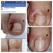 Retirada de espicula lateral mediana direira com granuloma paciente satisfeita sem dor .
