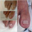Realizado  podoprofilaxia e tratamento para unhas  onicomicose com deslaminação e uso de fitoterapicos.Resultado com três meses de podologia.