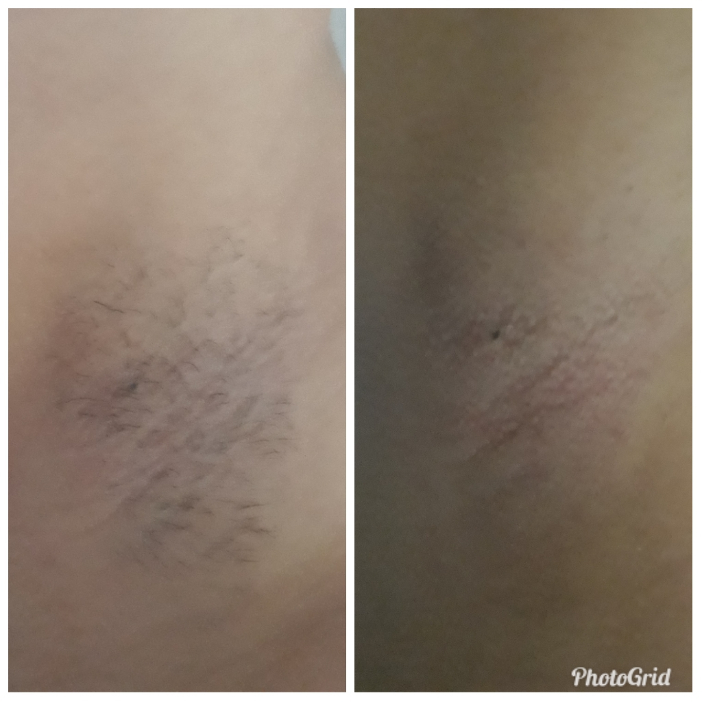 Antes e Depois

Depilação axila com cera tradicional de algas marinhas  outros estudante (esteticista) depilador(a)
