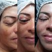 Revitalização olheiras e pálpebras! #jatodeplasma #belezasemidade