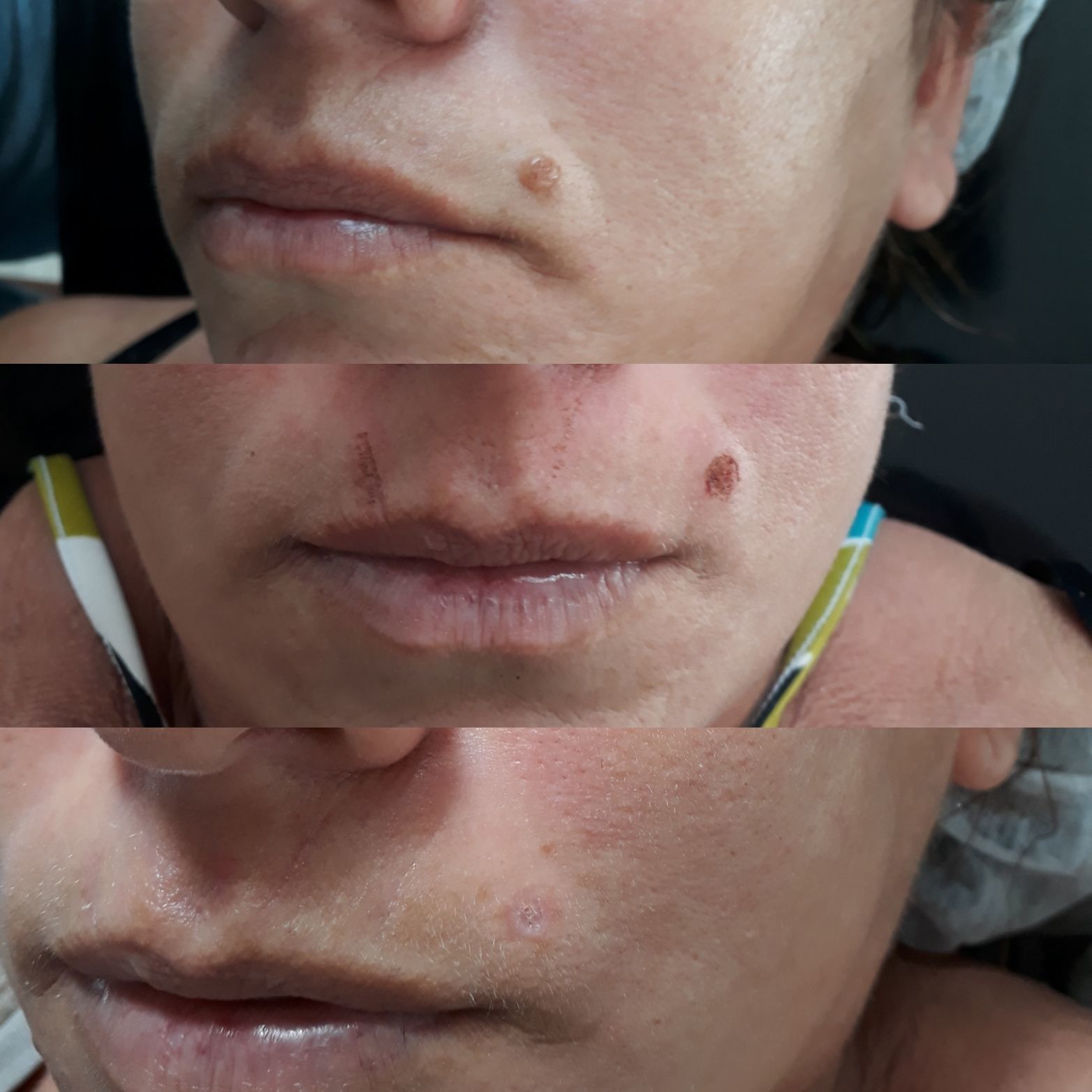 Extração de verruga! #belezasemidade #verruga #jatodeplasma estética esteticista dermopigmentador(a) designer de sobrancelhas micropigmentador(a)