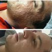 Tratamento de sequela de acnes #belezasemidade #rejuvenescimento #jatodeplasma #acnes