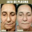Rejuvenescimento facial! #jatodeplasma #eletrocauterio #olheira #pálpebras #belezasemidade