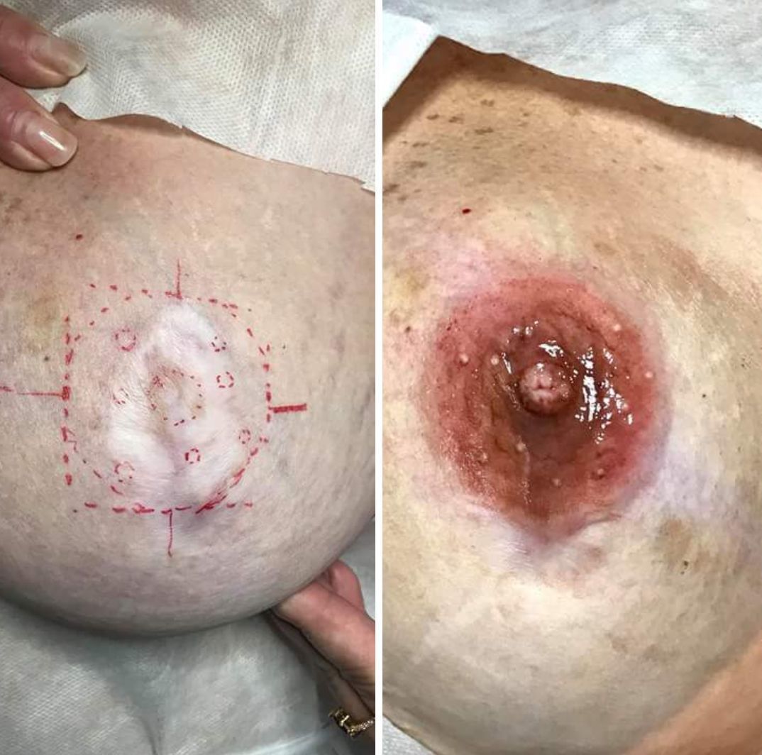 Reconstrução areola mamária #Paramedica #belezasemidade #micropigmentacao outros esteticista dermopigmentador(a) designer de sobrancelhas micropigmentador(a)