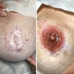 Reconstrução areola mamária #Paramedica #belezasemidade #micropigmentacao
