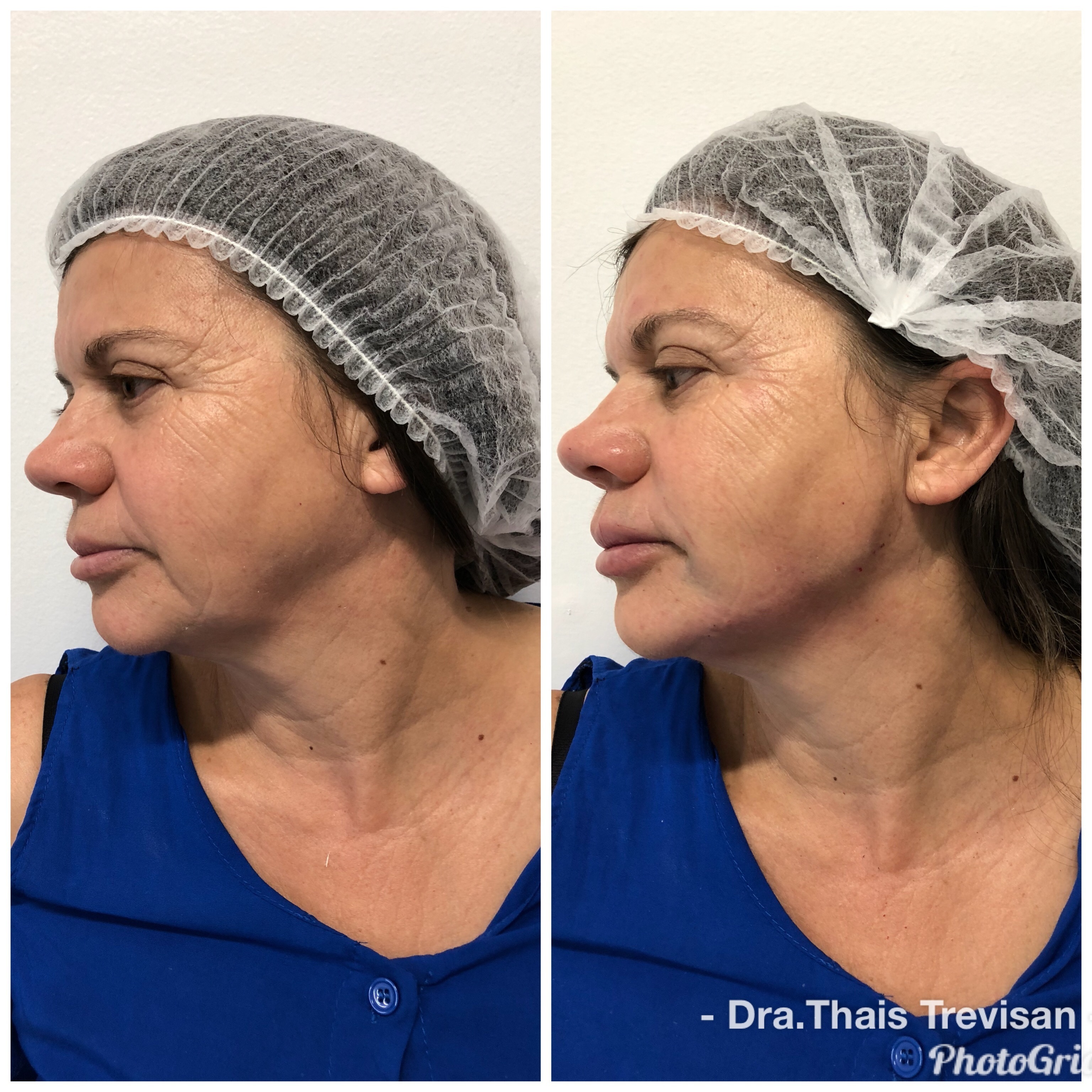 Harmonização facial  estética biomédico(a)