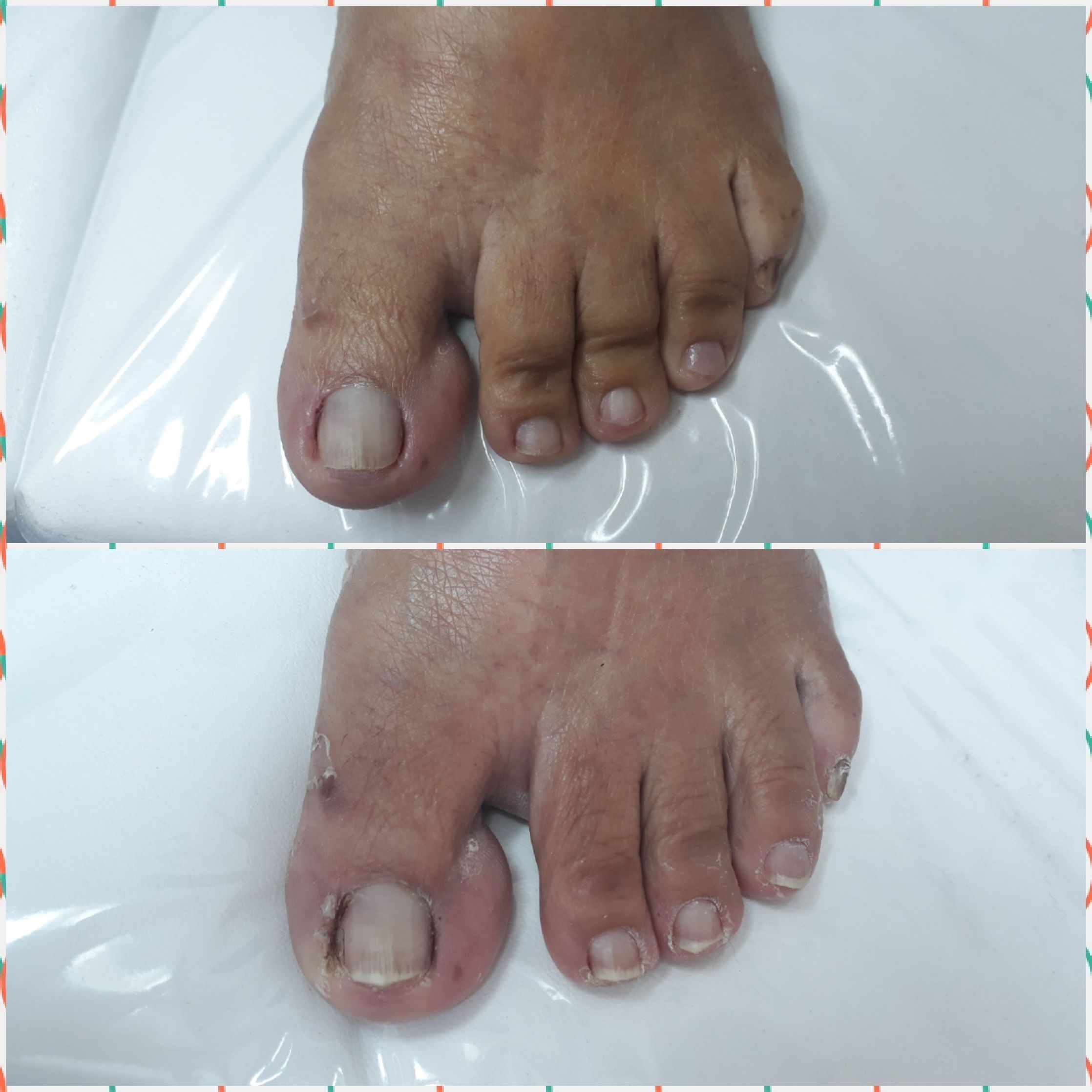 Podoprofilaxia + retirada de onicofose. podólogo(a)