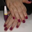 Cutilagem somente com cureta sem utilização de alicate. Cliente diabética.
