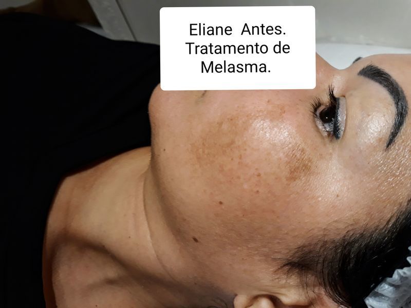Tratamento de Melasma  antes e depois esteticista cosmetólogo(a) consultor(a) outros