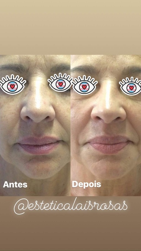 Tratamento para aumentar fibras de colágeno e elastina. Suavizando rugas e marcas de expressão. esteticista