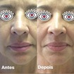 Tratamento para aumentar fibras de colágeno e elastina. Suavizando rugas e marcas de expressão.