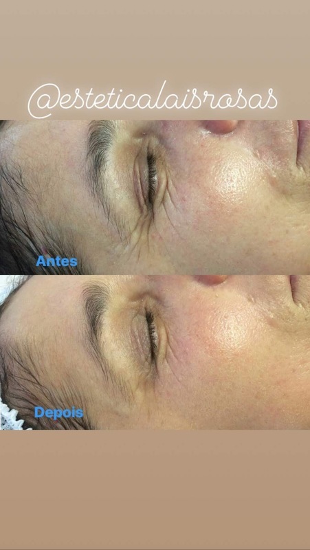 Tratamento para amenizar marcas de expressão e danos solares.  esteticista