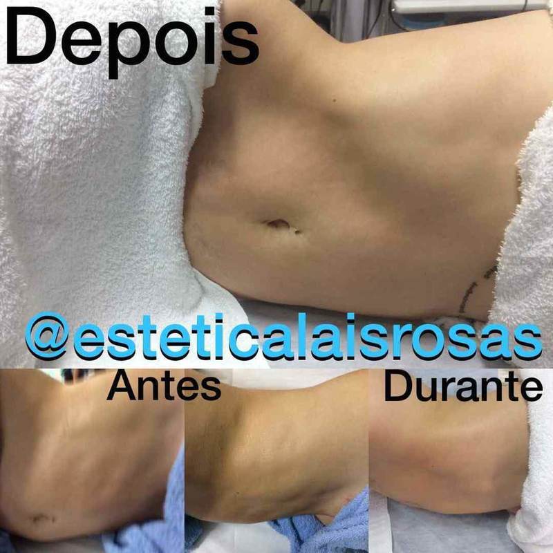 Tratamento pós operatório tardio, com fibroses. Remoção de fibroses e melhora no contorno abdominal.  esteticista