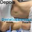 Tratamento pós operatório tardio, com fibroses. Remoção de fibroses e melhora no contorno abdominal. 