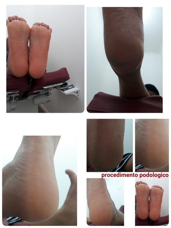 Tratamento de profilaxia e higienização dos pés.
 unha podólogo(a)