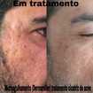 Microagulhamento antes e depois 1°sessão (tratamento para cicatrizes de acne).

#pelesaudavel #sppompeia #microagulhamento #dermaroller 