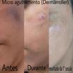 Microagulhamento  (dermaroller) tratamento  para melasma .


#pelesaudável #pelesemmanchas  #microagulhamento #dermaroller  #sppompeia #barrafunda  