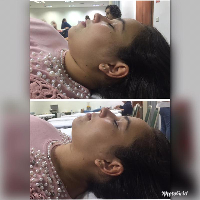 Drenagem linfática Facial Método Amanda Fernandes
1 Sessão antes e Depois  estética esteticista massoterapeuta aromaterapeuta depilador(a)